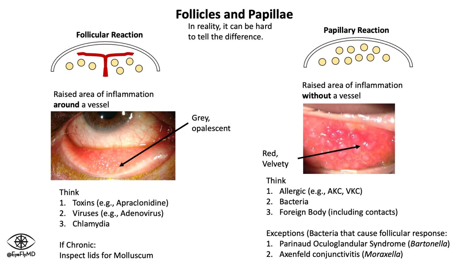 EyeFlyMD Educational Slides - Eye Fly MD