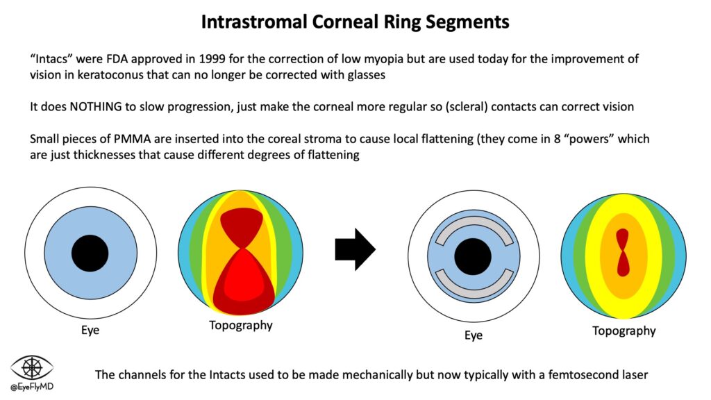 What is Corneal Ectasia and How to Manage it | OBN